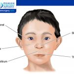 Fetal Alcohol Syndrome