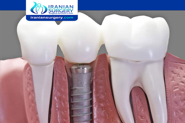 Is It Safe to Have Dental Implants in Iran?