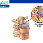 Microdiscectomy Success Rate