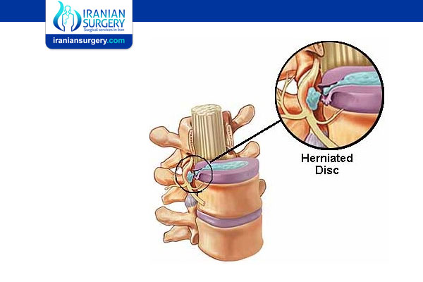 Microdiscectomy Success Rate