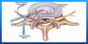 Microdiscectomy Success Rate