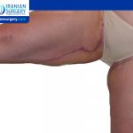 Thigh Lift Scars