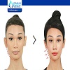 Facial Feminization Surgery Recovery Time