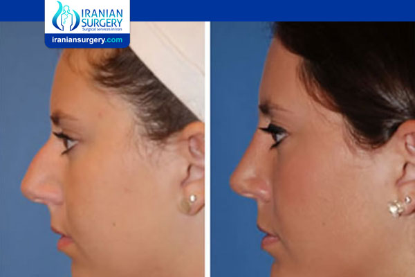 Rhinoplasty Plus Chin Augmentation