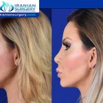 Rhinoplasty Fellowship in Iran