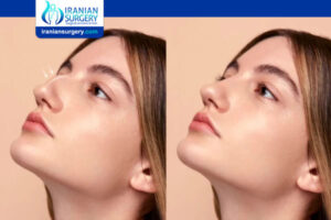 Can I Shower 3 Weeks After Rhinoplasty?