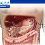 Pancreatic Cancer Stage 4