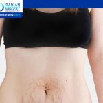 Gastrointestinal Problems After Tummy Tuck