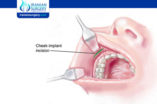 Cheek Implant Incision