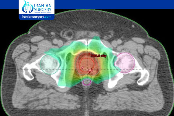 IMRT Radiation Prostate Cancer
