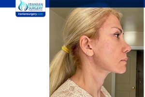 facelift surgery in Iran before and after