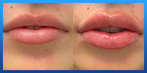 lip augmentation 