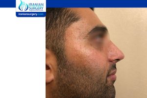 taping after rhinoplasty