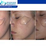 How Are Cheek Implants Placed