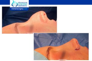 rhinoplasty in iran before and after