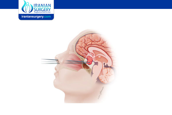 Endoscopic Brain Surgery