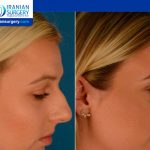 A Nose Cast after Rhinoplasty