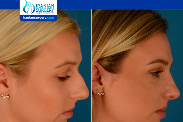 A Nose Cast after Rhinoplasty