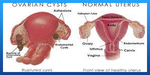 Can an Ovarian Cyst Last for Years?