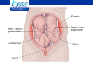 How your twins’ fetal positions affect labor and delivery