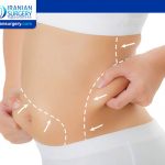 Different Types of Liposuction in Iran