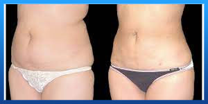 Liposuction scar