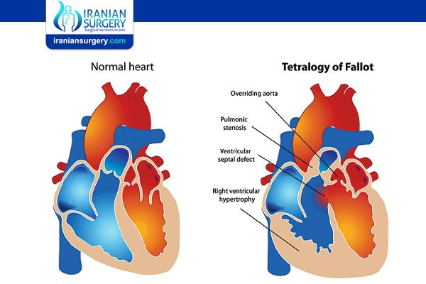   Congenital Heart Disease in Adults