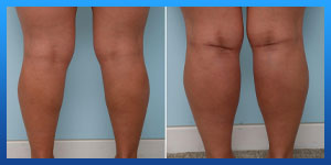 calf implants before and after pictures