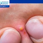 Abscess On Buttocks Cheek Treatment