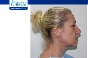 Before facelift surgery in Iran