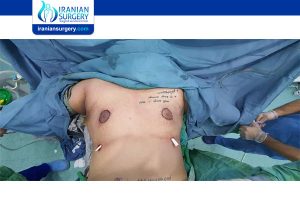 gynecomastia surgery cost in iran