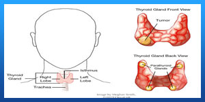 thyroid cancer treatment side effects