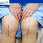 Disadvantages of Knee Replacement Surgery