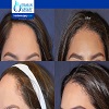 Hairline Lowering Surgery Female