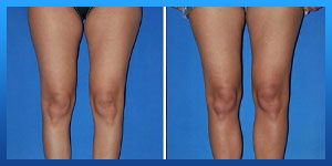 calf implants before and after pictures