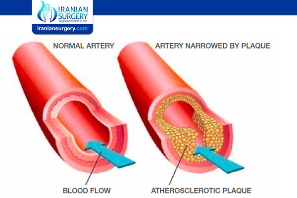 What Causes Coronary Artery Disease?