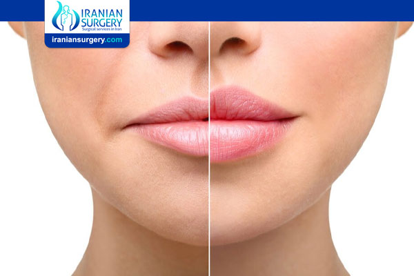 How to Reduce Swelling after Lip Fillers?