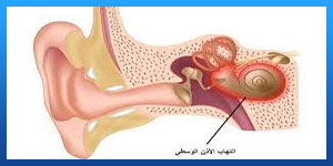 التهاب الأذن الداخلية