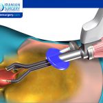 Single-Port Radical Prostatectomy