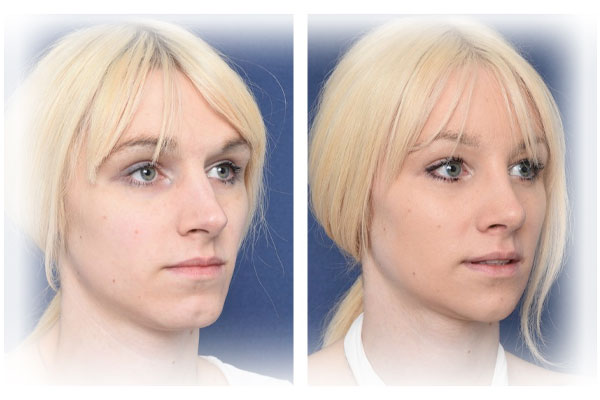 Facial Feminization Surgery Cost Iran Ffs Surgery