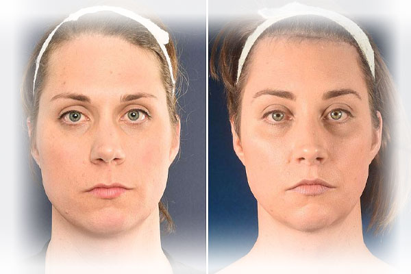 Facial feminization surgery