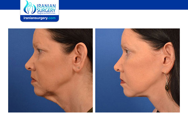 Swelling Under Chin After Facelift