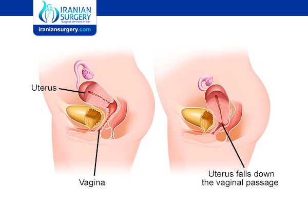 Uterine Prolapse Treatment