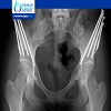 Hip disorders Surgery