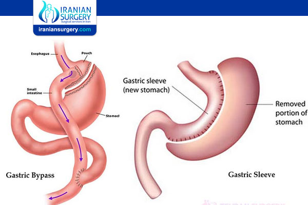 Gastric Sleeve surgery VS. Gastric Bypass surgery