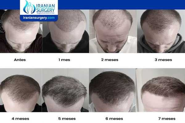Hair Transplant Timeline Month by Month