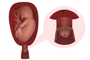 ربط عنق الرحم للحامل 