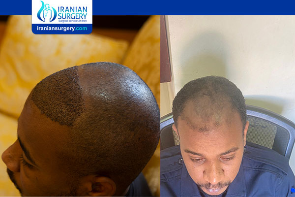Hair transplant review in Iran | Mosab from qatar