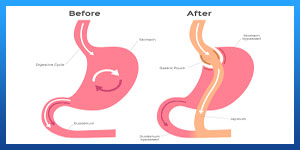 Gastric Sleeve surgery VS. Gastric Bypass surgery