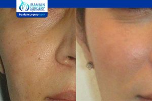How long does fat transfer to the face last?